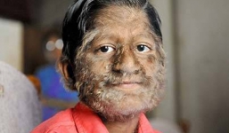 3 căn bệnh kỳ lạ nhất thế giới